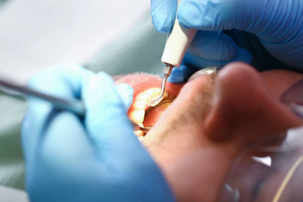 Best Chipped Tooth Repair Near Me  in Woodbranch, TX